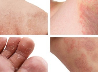 Recognising and treating mycosis of the skin or cutaneous mycosis